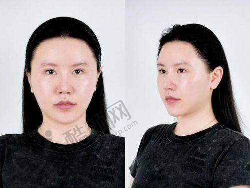 沈阳看颧骨高哪家医院好？沈阳北方整形医院性价比高