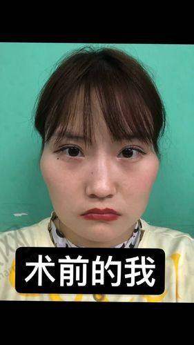 沈阳看颧骨高，这几家医院值得选