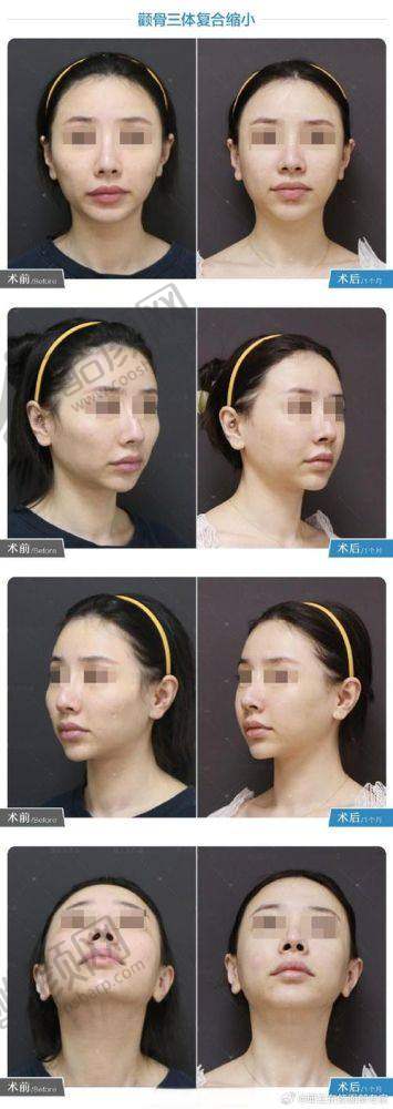 沈阳看颧骨高哪家医院好？沈阳友谊美容医院个性化服务佳