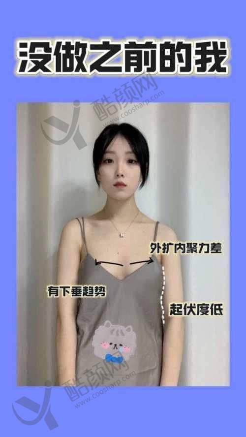 朱云隆胸水平怎么样可靠吗？