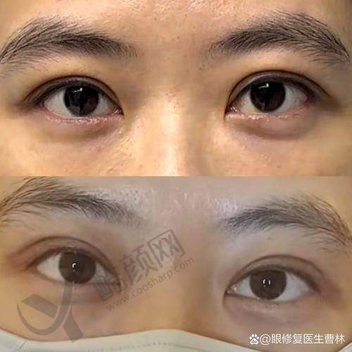 武汉双眼皮修复医生排名榜前十之谭琳医生