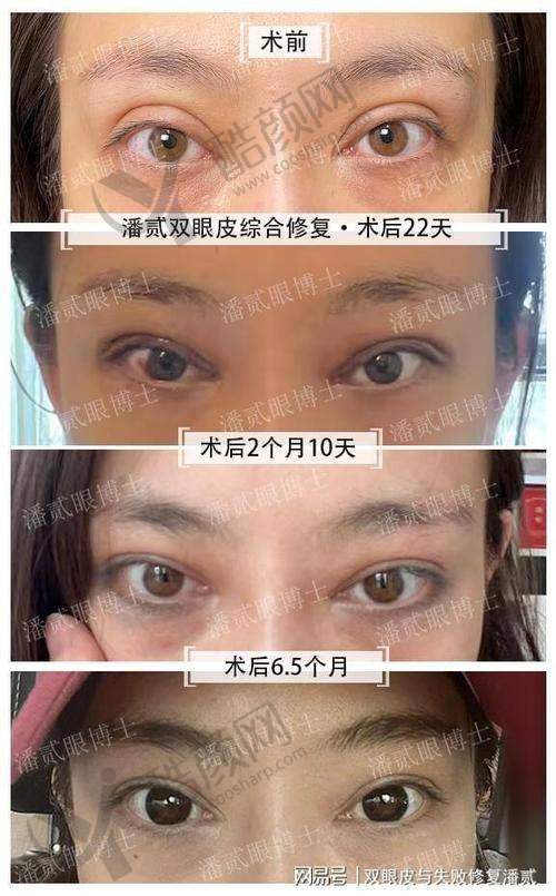 武汉双眼皮修复医生排名榜前十之冯晓玲医生