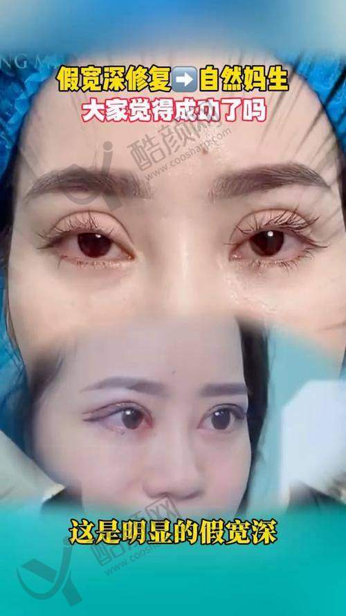 武汉双眼皮修复医生排名榜前十之陈又铭医生