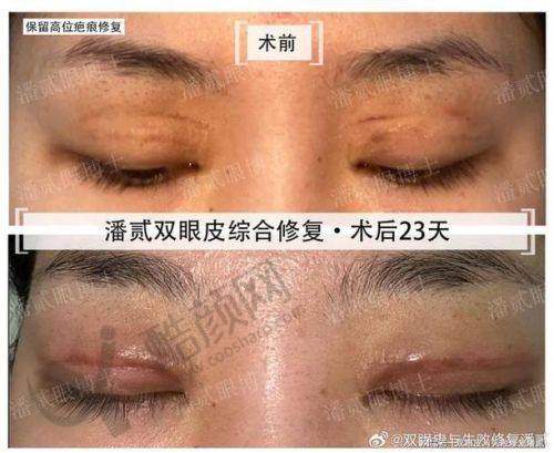 武汉双眼皮修复医生排名榜前十之付俊俐医生