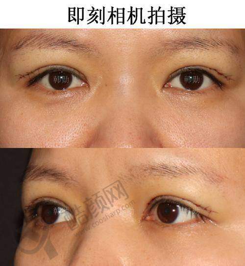 武汉双眼皮修复医生排名榜前十之王松山医生