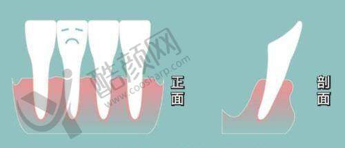 昆山嘉美奥整形：多样双眼皮形状任你选