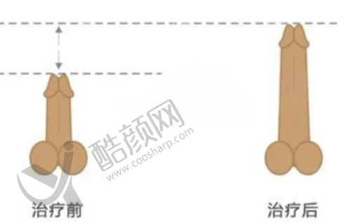 北京品塑医疗美容——顺义地区受欢迎的7D聚拉提医美机构