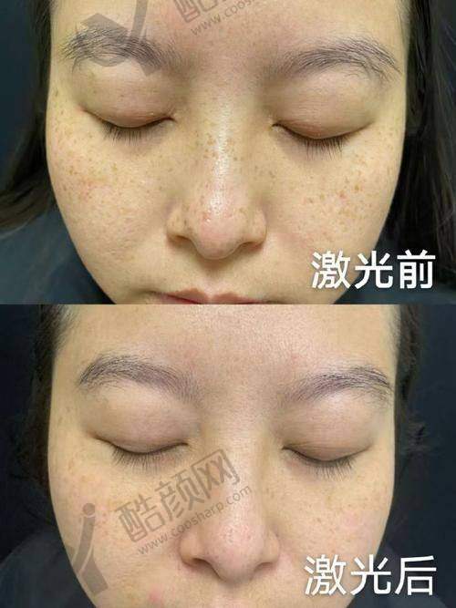 大连悦己时光医疗美容医院：小皮秒钻石激光，私密体验佳