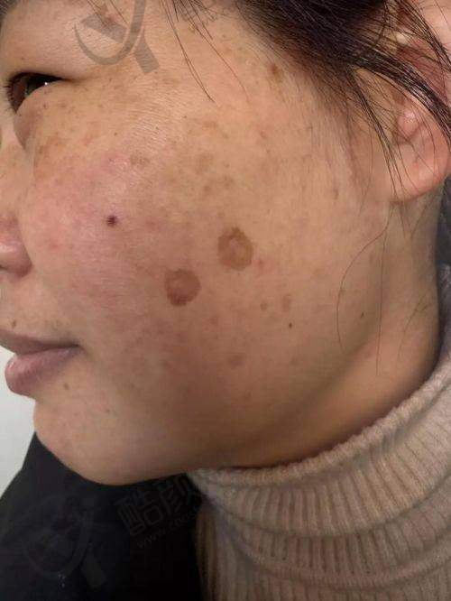大连爱德丽格医疗美容：皮秒激光方案个性化，仪器可查验