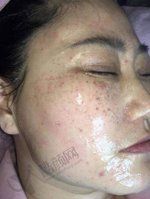 大连美天整形医院：3步零损伤祛斑法，成效看得见