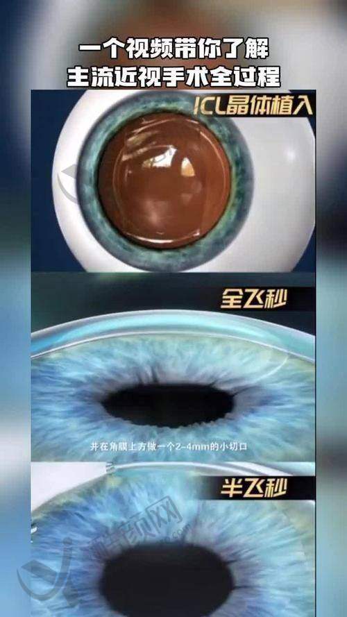玉林爱尔眼科医院TICL晶体植入手术29500元起，连锁品牌专业护航视力矫正！ 