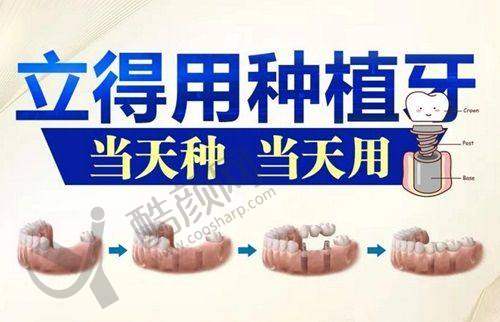 种牙纠结韩瑞？综合考量选对适合自己的种植体
