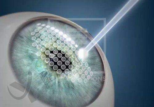 北京熙仁眼科医院角膜塑形镜价格6800元起，专属定制服务超贴心 