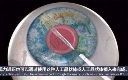 杭州爱尔眼科医院ICL晶体植入手术真实评价