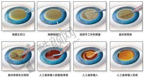 重庆渝州华厦眼科霍妍白内障手术水平怎么样可靠吗？