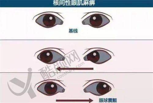 有效控制近视进展，成效看得见