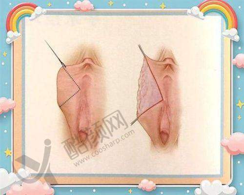 北京做私密整形去哪家医院好？——北京画美整形