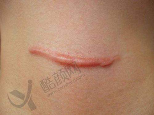 深圳鹏程医院疤痕科医生团队：经验多技术强
