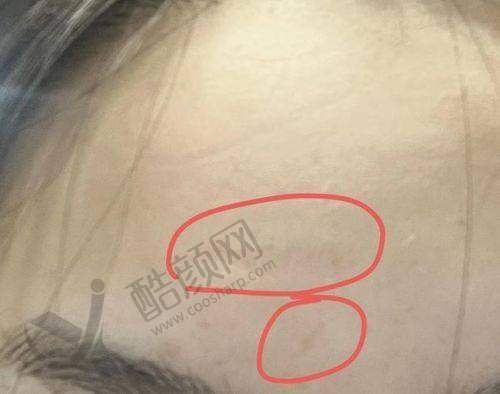 深圳鹏程医院疤痕科开展项目：多样选择满足需求