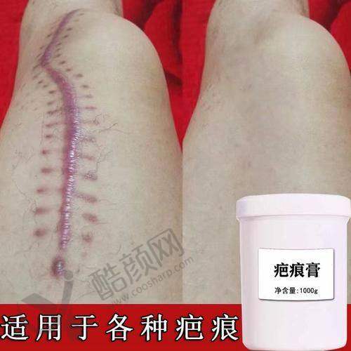 深圳鹏程医院疤痕科价格表：明码标价性价比高