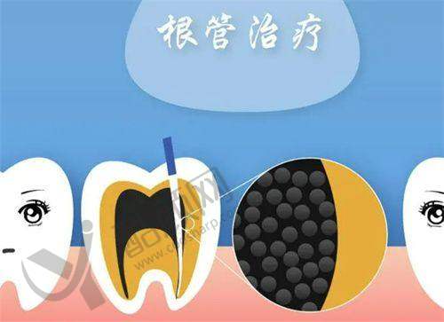 临汾美瑞臣口腔医院根管治疗项目优势