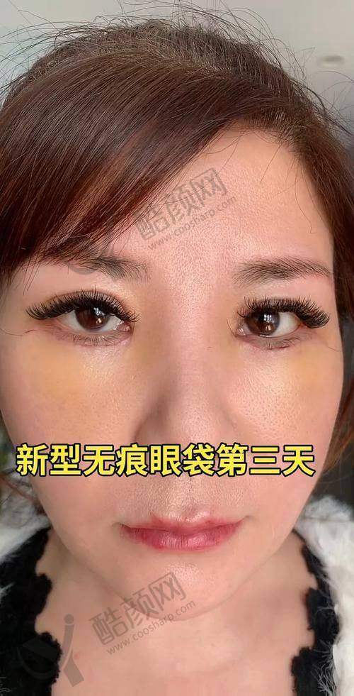 抖音580元祛眼袋：总结与建议