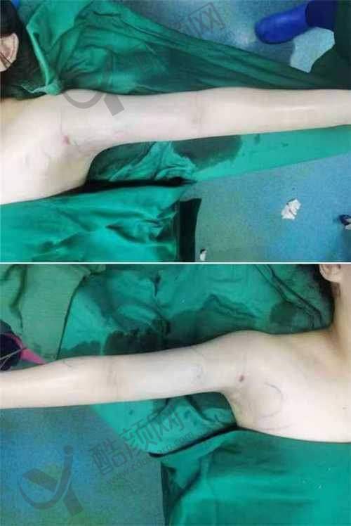 上海艺星双上臂部隐痕吸脂项目优势