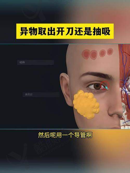 王阔远医生面部减容成功实例：成效显著获认可