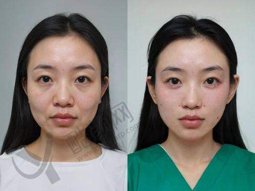 北京蒂凡妮王志坚医生面部提升成功实例