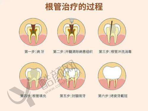 大庆优根口腔医院根管治疗400元起,数字化诊疗+经验医生,治疗舒适又安心