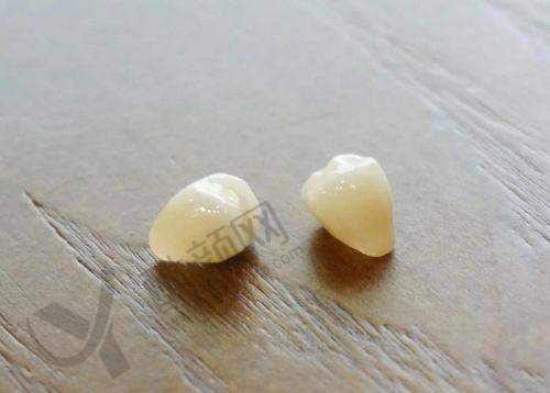 运城美瑞臣口腔医院樊跃旭医生镶全瓷牙960元起,精细化定制还原自然美牙