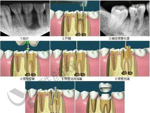 商丘京德口腔医院医生做根管治疗480元起,优质设备与经验医生护航看牙体验