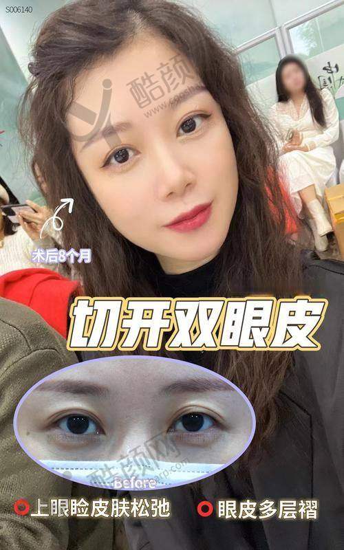 上海眼王张宇医生双眼皮手术实例