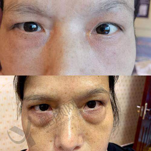 分享我在广州健丽去眼袋的经历！为啥选广州健丽