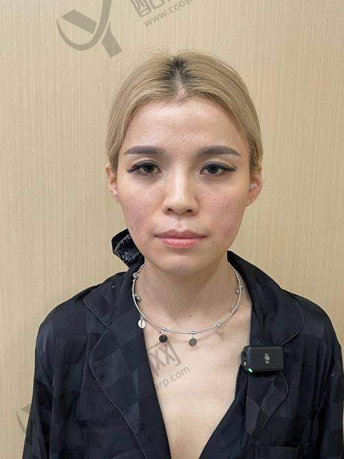 日本童颜教父陈志博士面部抗衰实例