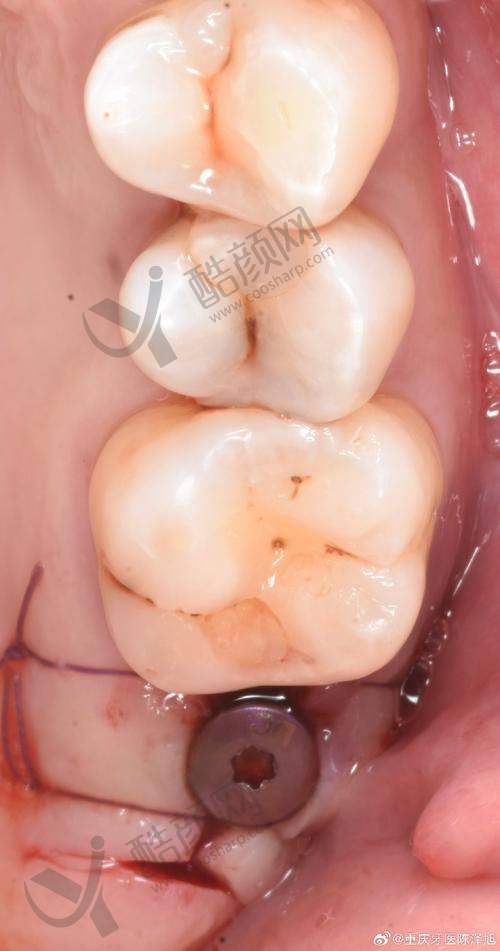 徐州医大鼎植口腔谢正新医生做韩国登腾烤瓷种植牙3980元起,缺骨种植技术靠谱