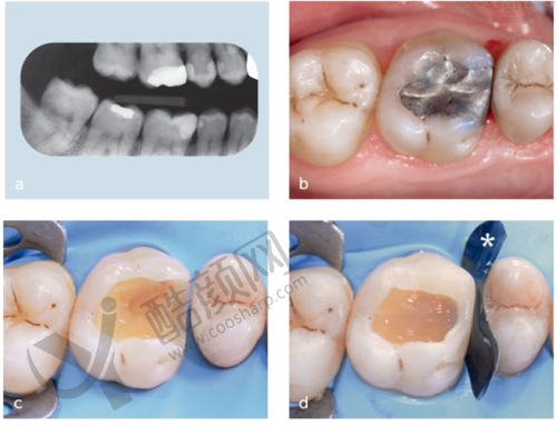 大庆世同优根口腔医院陈岩医生树脂补牙260元起,数字化诊疗体验佳口碑好