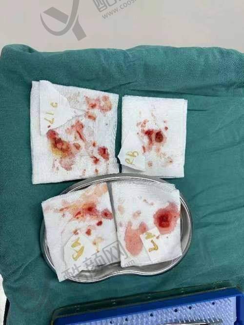 北京煤医医疗美容医院：取出修复抑制同步进行