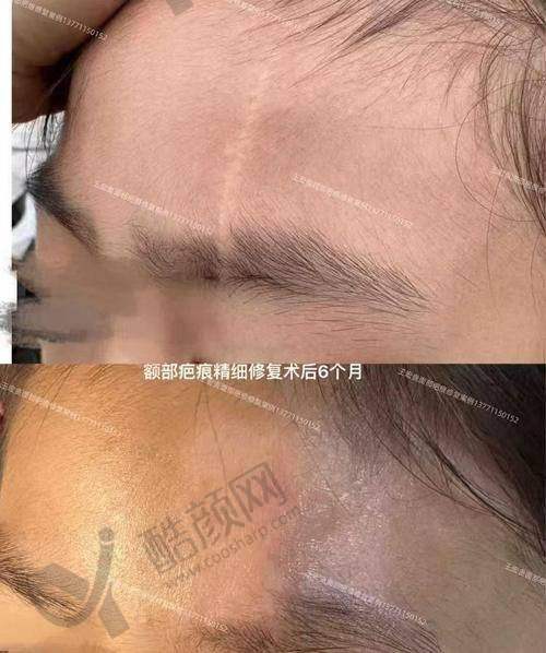 上海时光整形医院疤痕科：大面积创伤疤修复强者