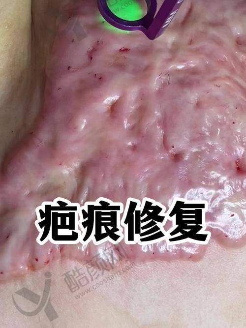 上海赛米整形医院疤痕科：敏感肌红疤修复骨干医生
