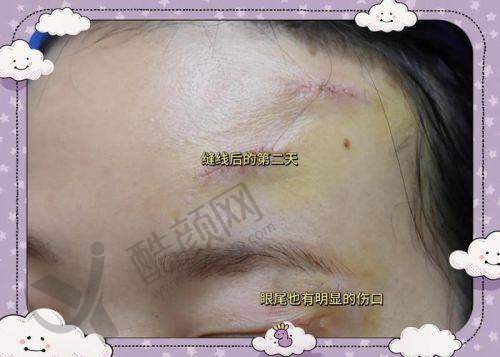 上海海华医院疤痕科：剖腹产疤修复优选