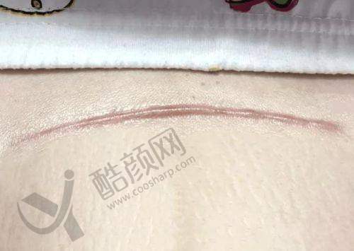 上海江城疤痕修复中 心：色素疤痕修复能手
