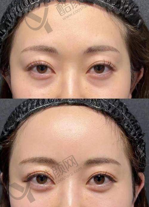 南京美贝尔美容医院：内路法隐痕去眼袋技术出色