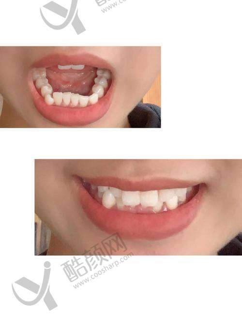 大理拜博口腔医院镶烤瓷牙仅需500元起/颗,专业团队定制方案,优质服务重塑自信笑容