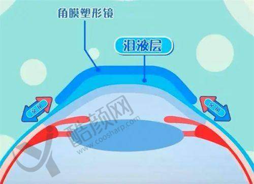 上海黑马眼科杨亚波医生:ICL晶体植入骨干医生