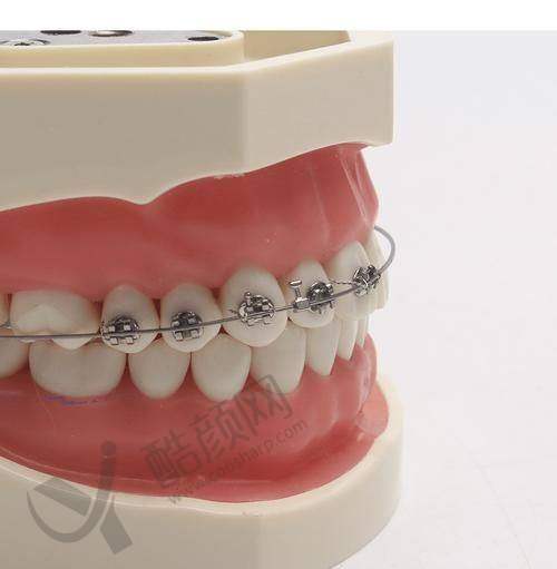 丹阳睿仕口腔庞磊医生金属牙齿矫正价格5800元起,双店同价服务贴心靠谱