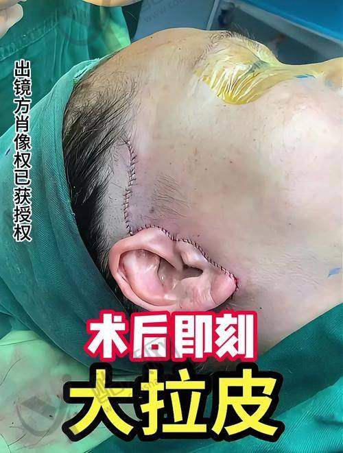 眭云鹏拉皮手术实例
