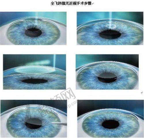 上海新视界眼科全飞秒手术的真实评价