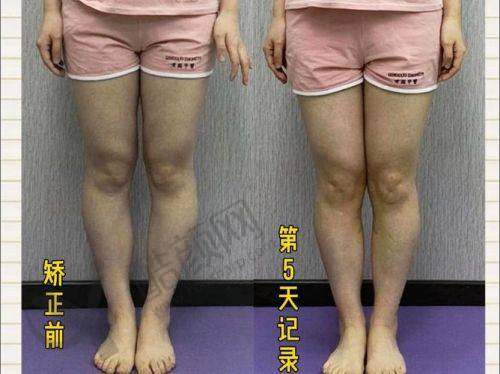 西安西美医院直腿术适合哪些人？