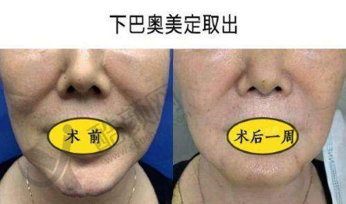 广州荔湾区人民医院整形科：经验多的奥美定取出医院